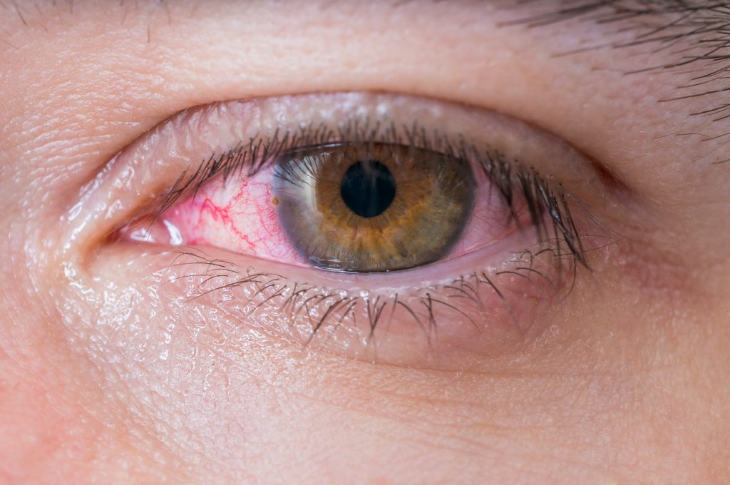 Mejores medicamentos para tratar la Infección en Ojos