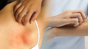 Imágen de Alergias en la Piel