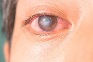 Imágen de Úlcera Corneal