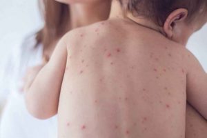 Imágen de Rubéola
