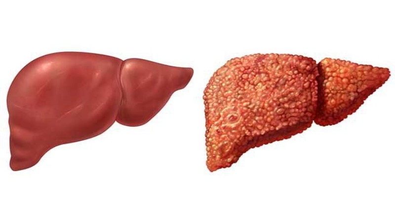 Causas y factores de riesgo del hígado graso