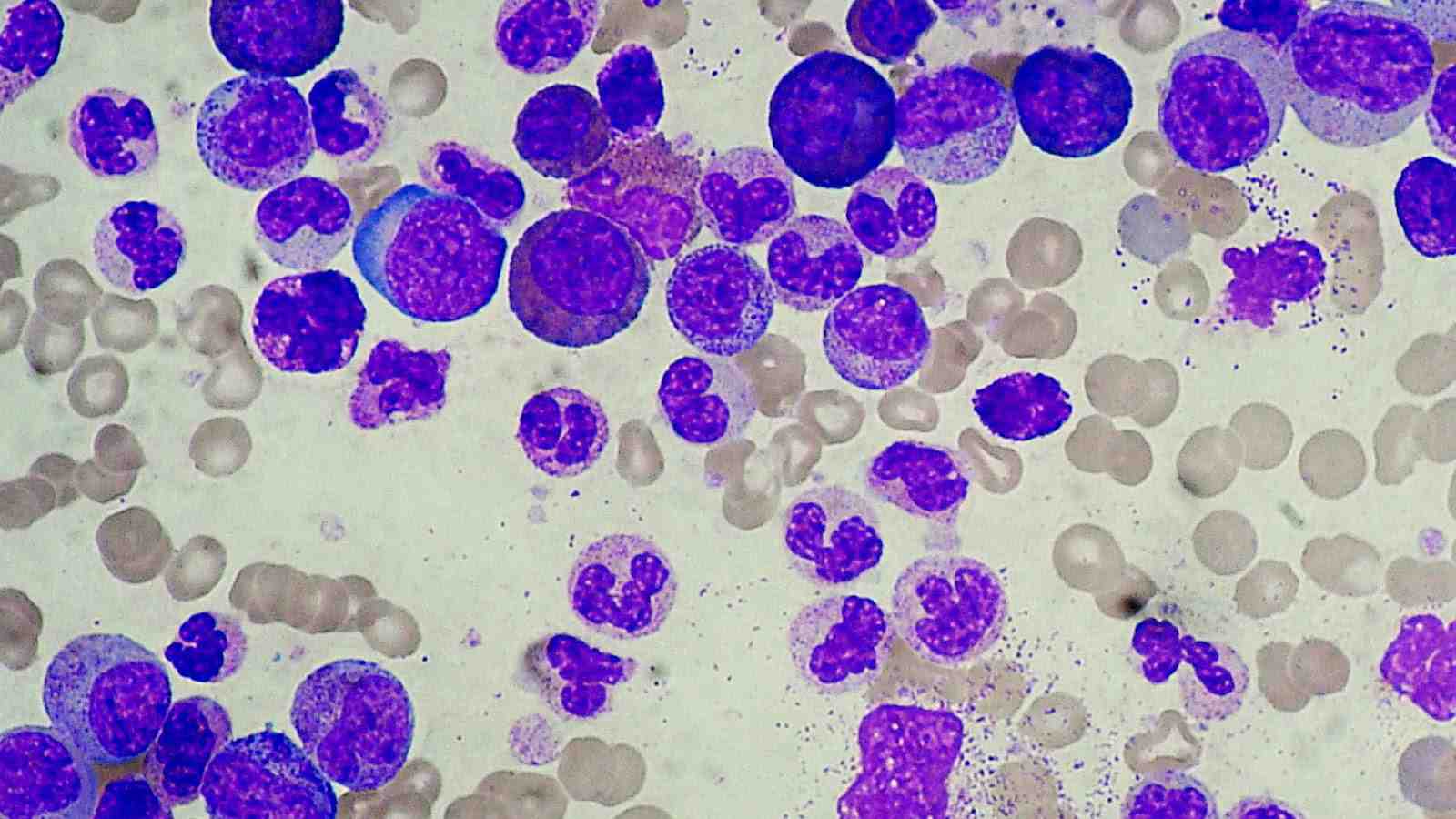 Por qué se produce la leucocitosis