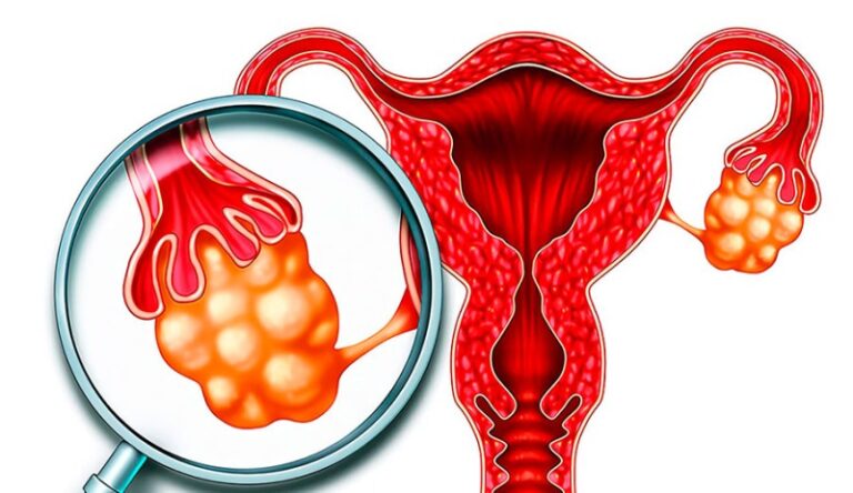 Quistes En Los Ovarios Causas Síntomas Y Tratamiento 2201